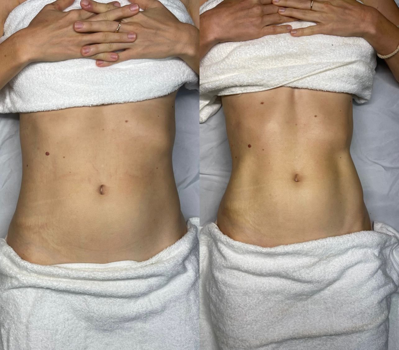 Vergleichende Ansicht des Bauchs derselben Klientin unmittelbar vor und nach einer 60-minütigen Lymphdrainage- und Maderotherapie-Sitzung.